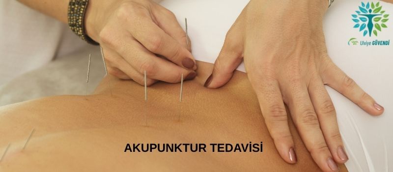 Akupunktur İğnesi Nedir? Merak Edilenler