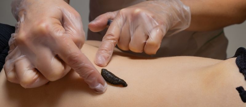 Sülük tedavi hangi durumlarda yapılmalı