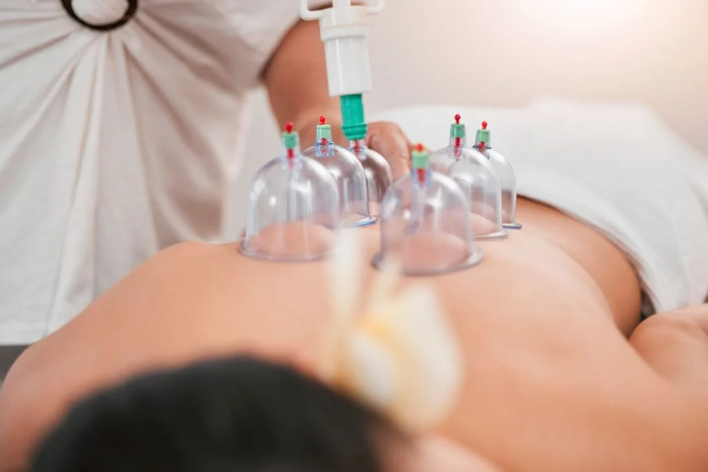 Hacamat Günleri 2026 3 Hacamat günleri kapsamında sırt bölgesine uygulanan hacamat işlemi