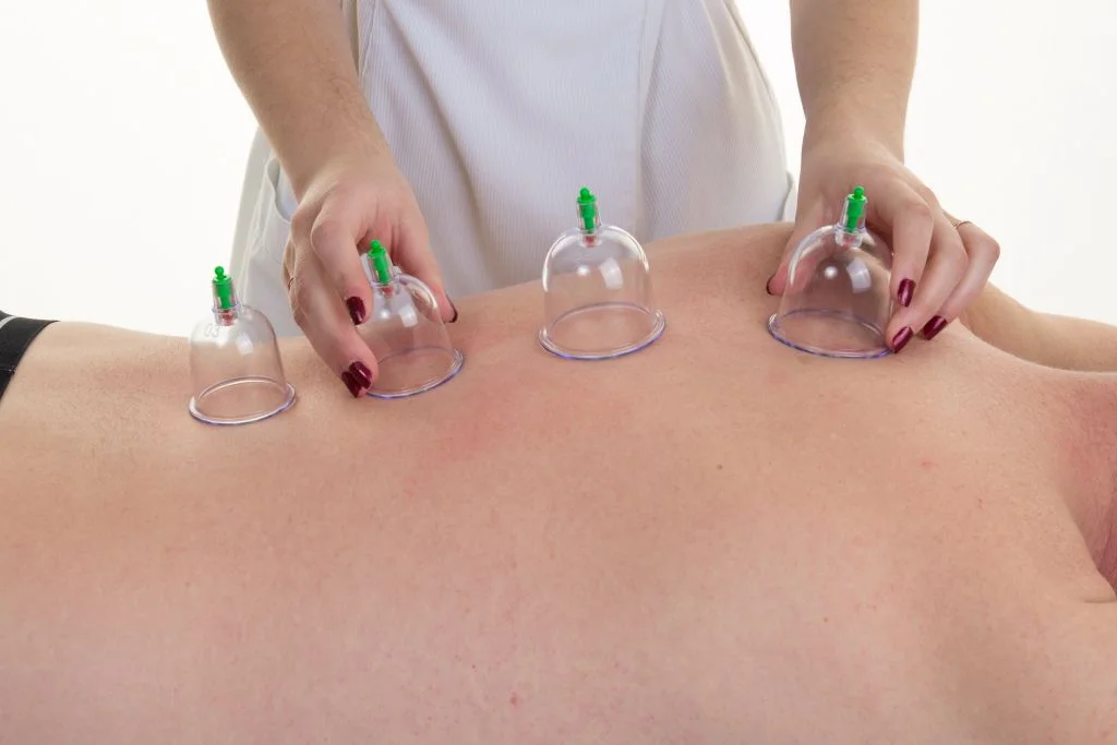 Hacamat Günleri 2026 2 Sırt bölgesine uygulanan hacamat işlemi sırasında kullanılan kupalar