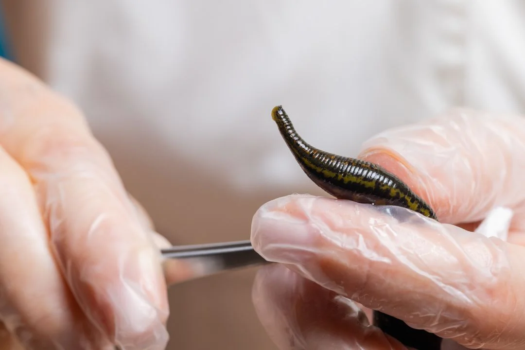 Hirudoterapi uygulamasında tıbbi sülüğün hekim kontrolünde güvenli şekilde yerleştirilmesi