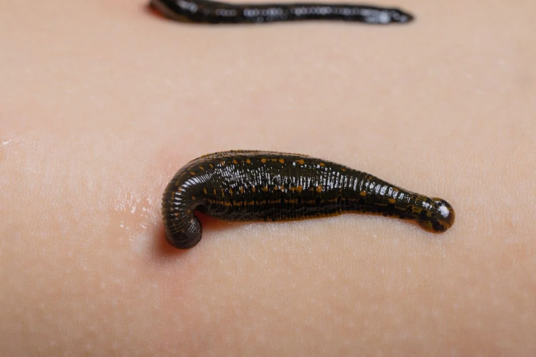 hirudoterapi hekim kontrolu tibbi suluk uygulamasi