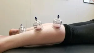 Bacakta hacamat noktaları, klinik ortamda bacağa uygulanan tıbbi hacamat kupaları