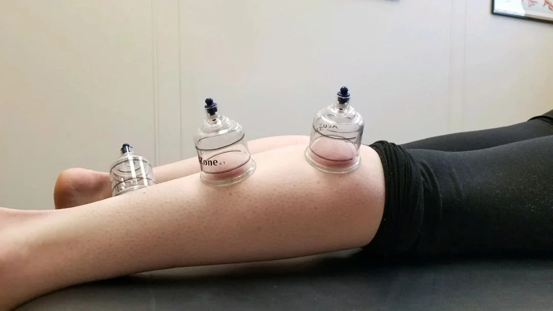 Bacakta hacamat noktaları, klinik ortamda bacağa uygulanan tıbbi hacamat kupaları