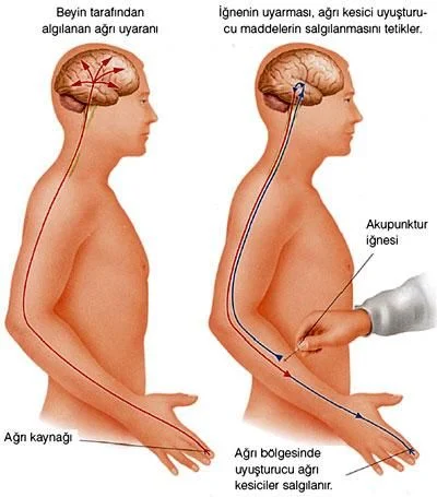 Master Tung akupunkturda iğne uyarısının sinir sistemi üzerinden beyne iletilmesini gösteren görsel